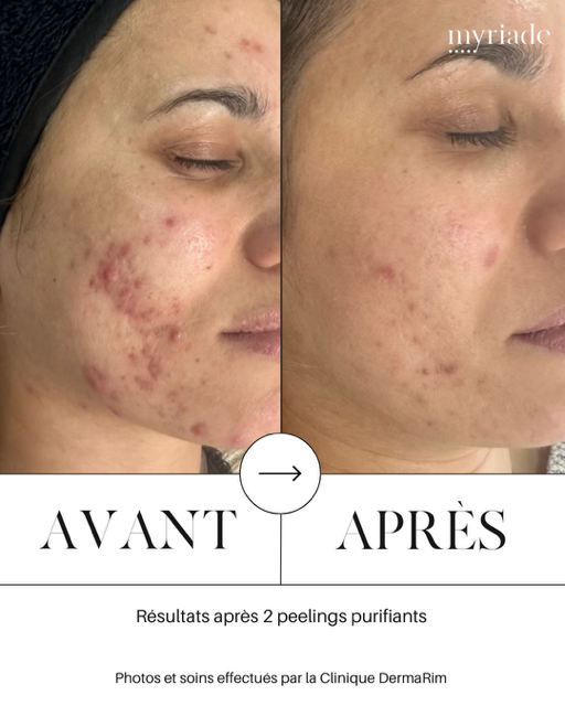 avant-apres peeling concept myriade