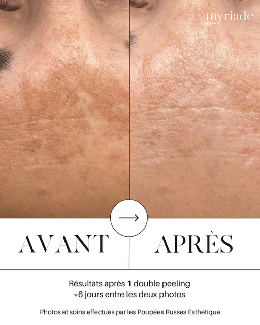 avant-apres peeling concept myriade