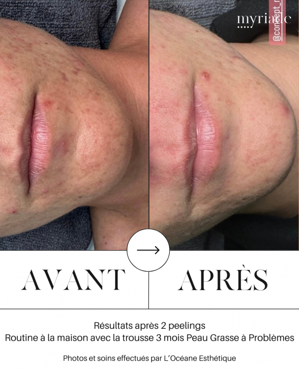 avant-apres peeling concept myriade