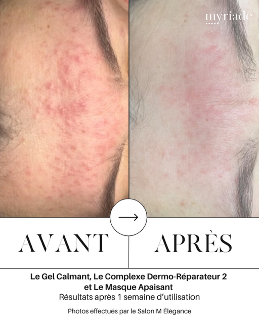 avant-apres peeling concept myriade