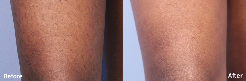 avant-après laser triton cuisses foncées