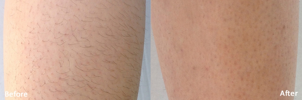 avant-après laser triton jambes