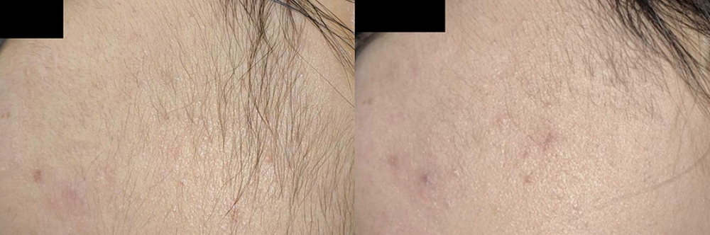 avant-après laser triton visage