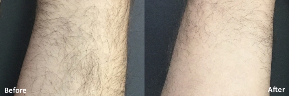 avant-après laser triton bras homme